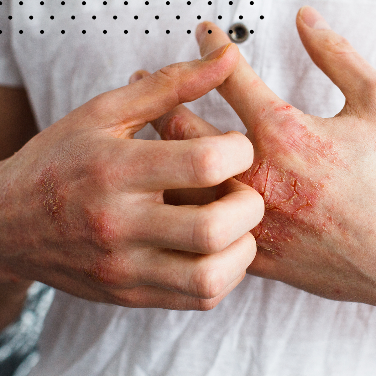Atopic Skin